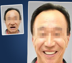 真人案例：廈門宏沅膛口腔60歲老人種植牙術(shù)前術(shù)后效果對(duì)比