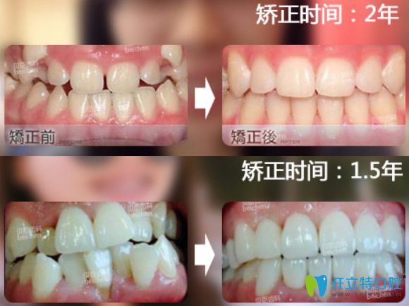 成都貝臣齒科集贊優(yōu)惠項目價格表及牙齒矯正技術(shù)大PK