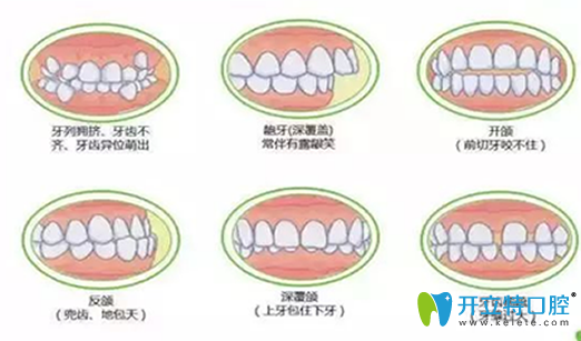 深度揭秘：在做牙齒矯正之前，你不得不了解的17個(gè)問題