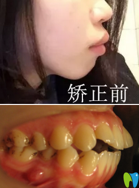 來(lái)看本人在廈門登特口腔做牙齒矯正減3200元費(fèi)用