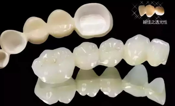 為什么全瓷牙價格比烤瓷牙貴 兩者優(yōu)缺點PK后就知區(qū)別在哪