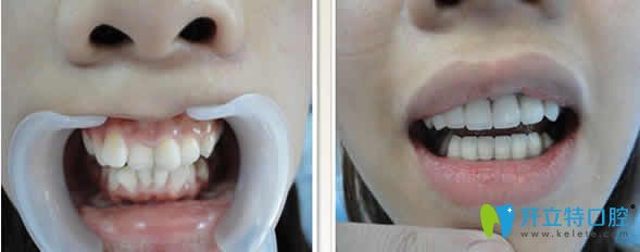 合肥世佳口腔牙齒矯正案例前后對比圖
