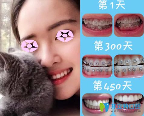 成人矯正牙齒效果好嗎？看上海伊爾意口腔正畸前后對比圖