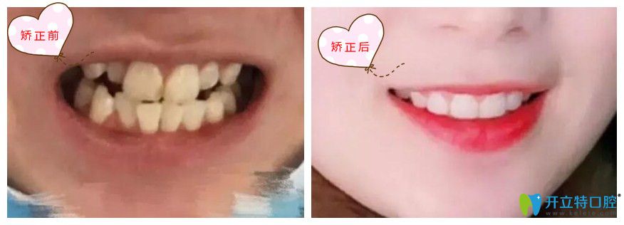 次牙齒矯正沒做好,我在北京南區(qū)口腔做了二次正畸
