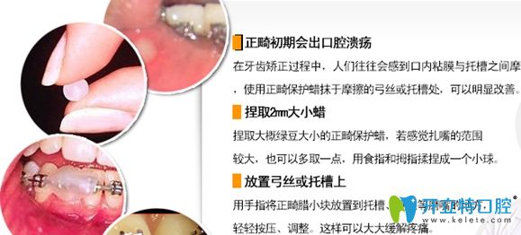 牙套托槽磨嘴怎么辦，可使用正畸蠟來保護口腔粘膜