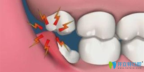 無相對咬合關系的智齒