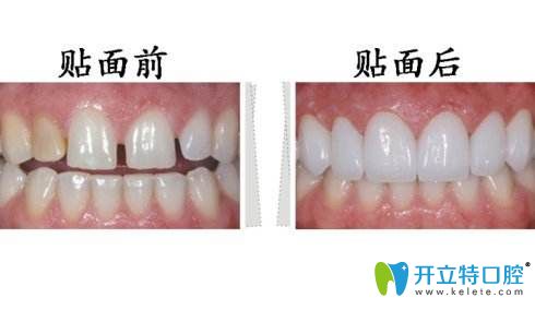 牙齒貼片前后對(duì)比