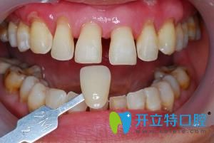 上海牙齒貼片多少錢(qián)?精心整理牙貼面價(jià)格含樹(shù)脂瓷貼面區(qū)別
