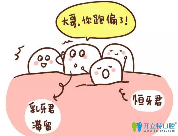 乳牙滯留恒牙萌出會導致牙列不齊的情況出現(xiàn)