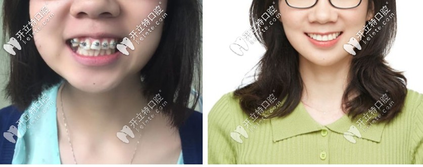 爆我箍牙前后臉型對比照圖，你還覺得門牙外凸沒必要矯正
