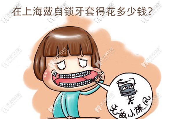 目前在上海戴金屬自鎖牙套的價格大概是多少？