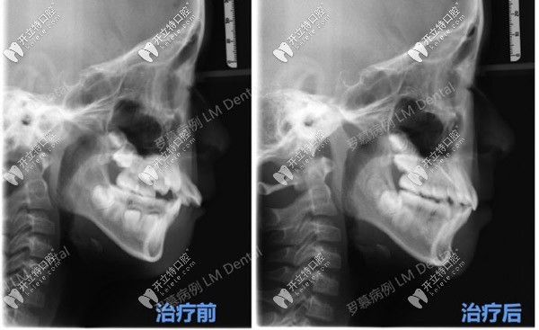 10歲女孩牙齒深覆合采用羅慕早期干預矯治后的效果忒明顯