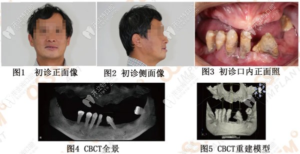 在先鋒鉆導板的輔助下,全口即刻負重咬合重建的病例完成了