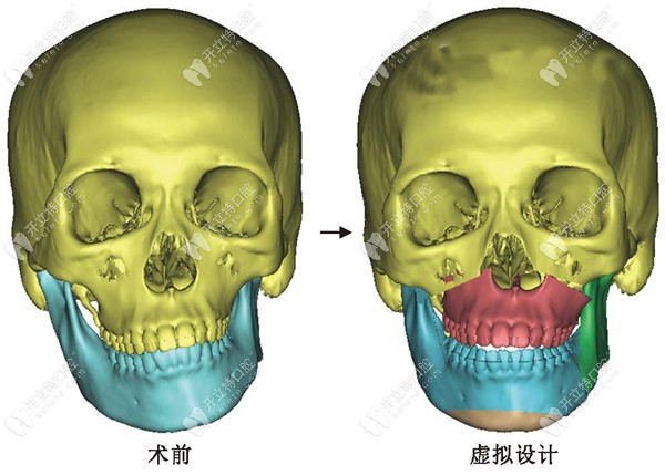 上海哪個醫(yī)院做正頜手術(shù)好,選個厲害的頜面外科醫(yī)生很關(guān)鍵